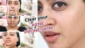 Salicylic Acid: Acne Prone Skin Care Routine