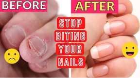 How to Stop Biting Your Nails | Tricks To Quit Nail Biting | Ways to Stop Biting Your Nails! Nail