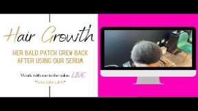 Her bald patch grew back after using our serum |Work with me