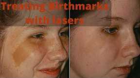 ✨ Birthmark Skin Care | Effective Solutions & Treatment Options 🌟