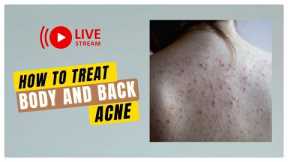 How To Treat Back and Body Acne. This's what i did