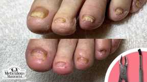 👣Thick Yellow Toenails Before and After #nails #satisfying