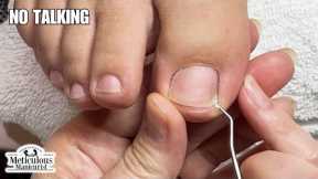👣 Deep Sidewall Toenail Cleaning - No Talking #nails #satisfying
