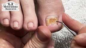 👣 Big Toenail Fix at Home #nails #satisfying