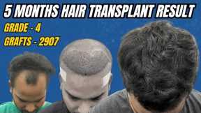Hair Transplant In Kolkata || Best Result & Cost of Hair Transplant in Kolkata || 5 Months Result